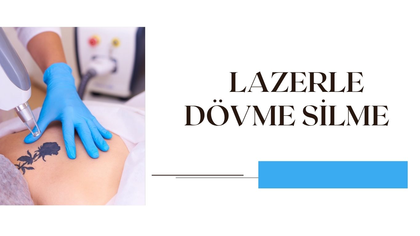 Ankara-lazerle-dovme-silme