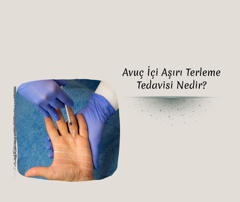 Avuç İçi Aşırı Terleme Tedavisi Nedir?