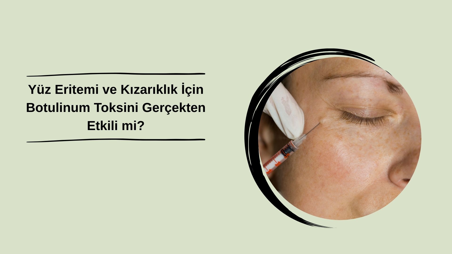 Yüz Eritemi ve Kızarıklık İçin Botulinum Toksini Gerçekten Etkili mi?