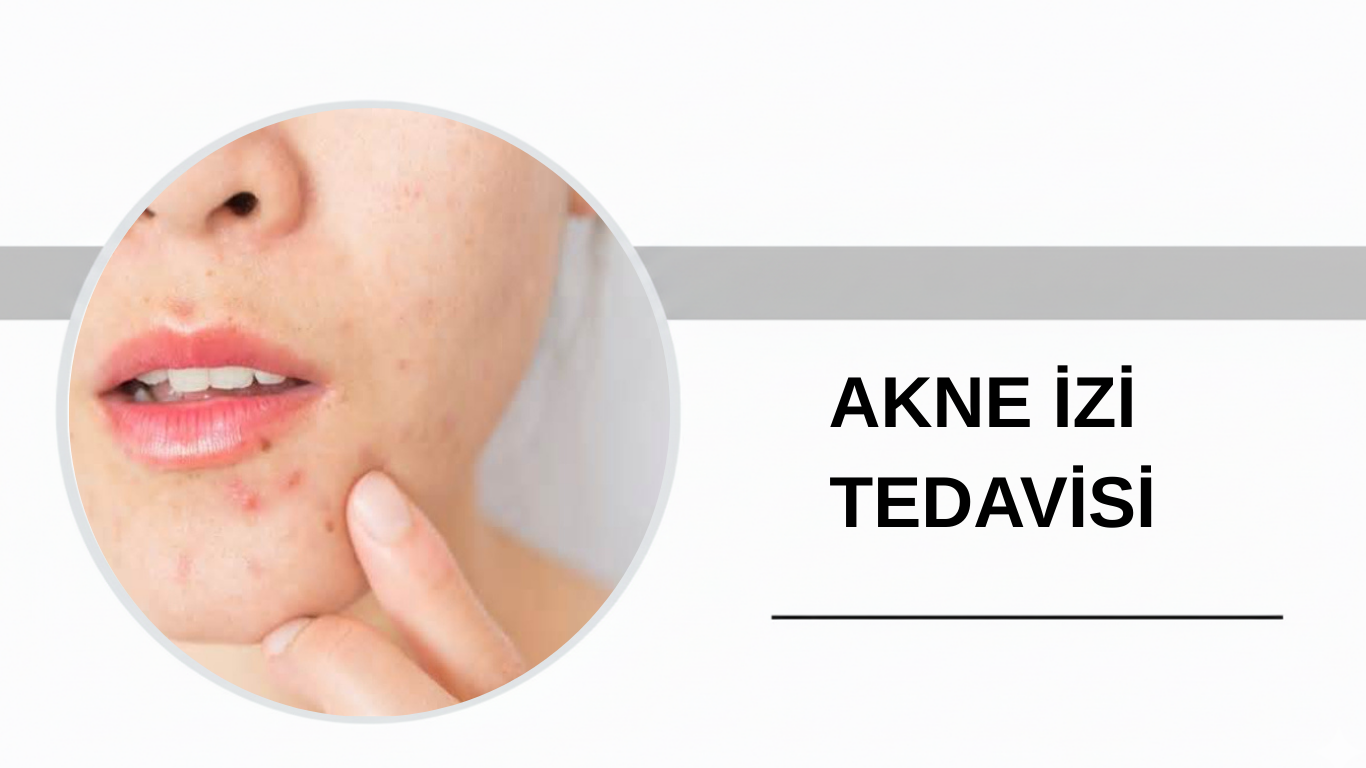 Ankara Akne İzi Tedavisi