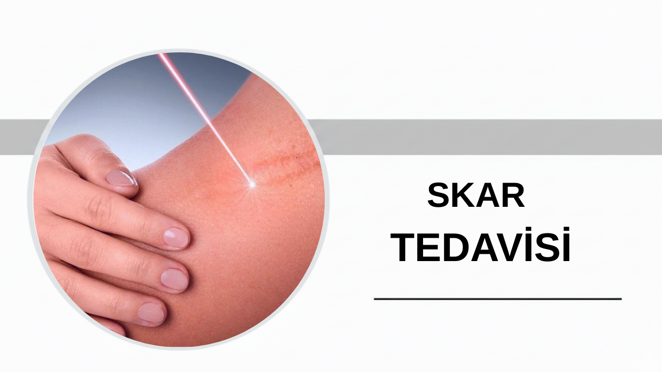 Ankara Skar Tedavisi