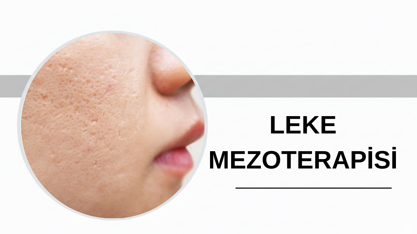 Ankara Leke Mezoterapisi