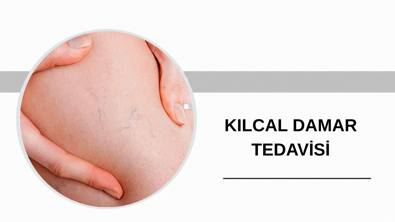 Ankara Kılcal Damar Tedavisi