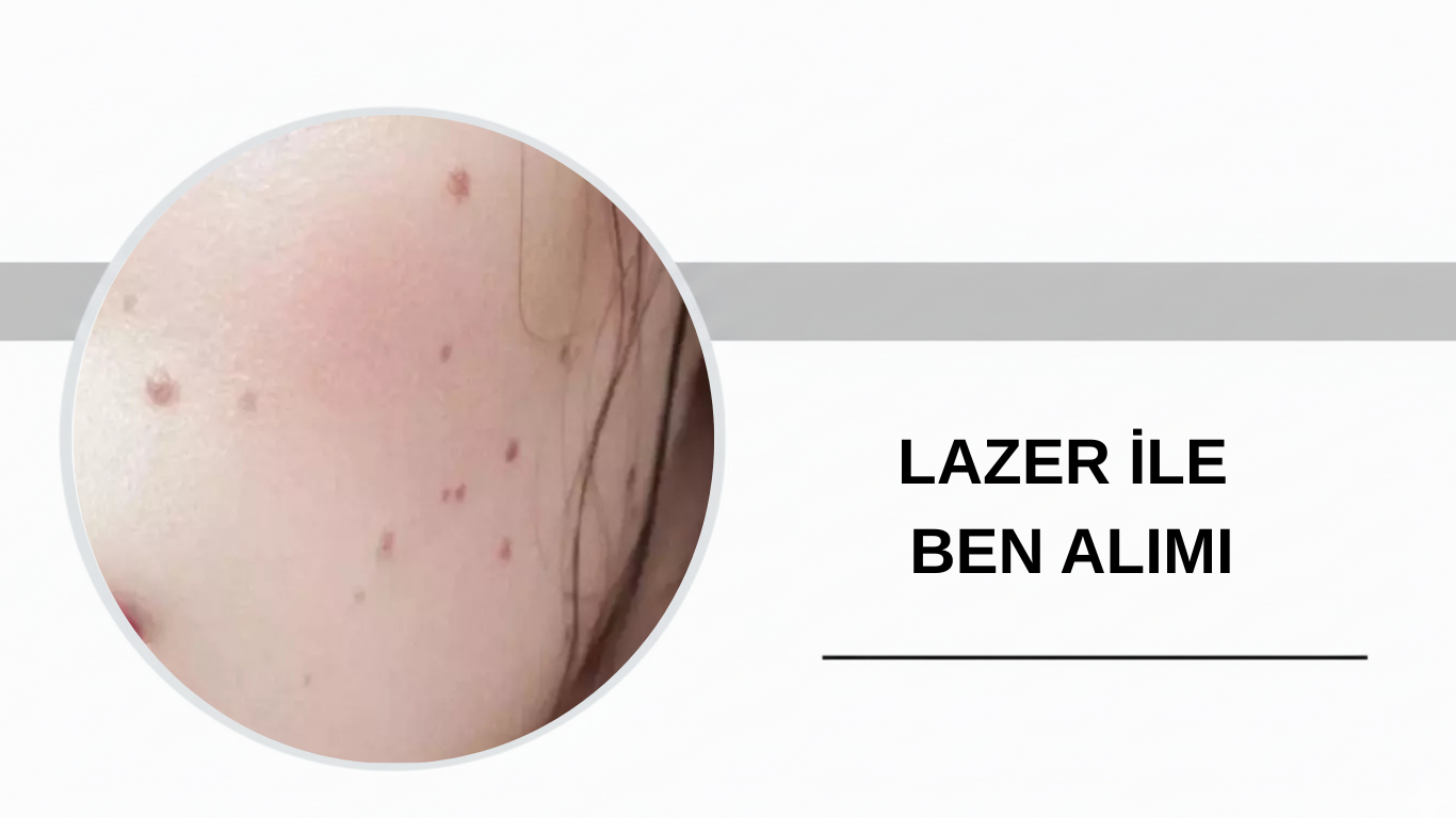 Ankara Lazer ile Ben Alımı