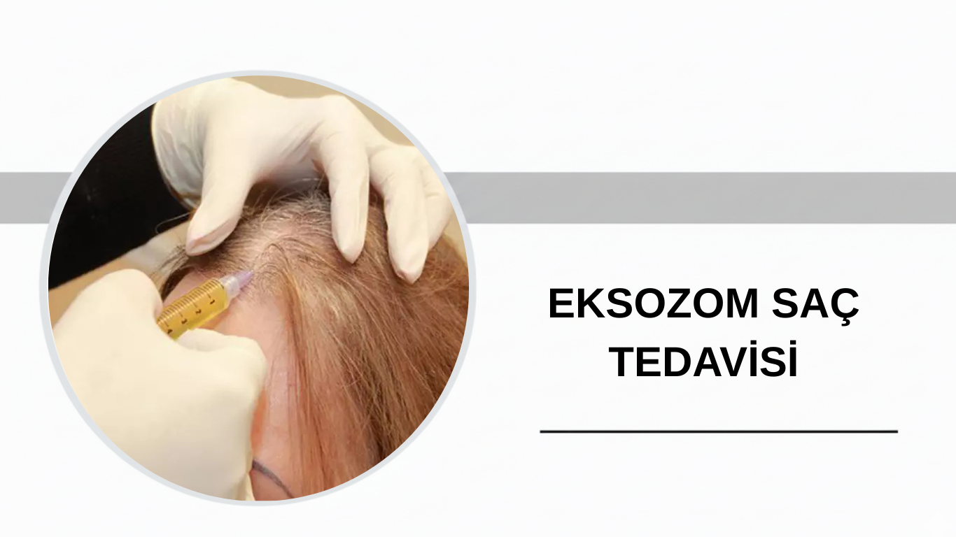 Ankara Eksozom Saç Tedavisi